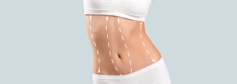 مینی ابدومینوپلاستی